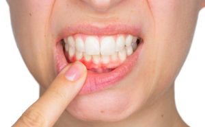 Chảy máu chân răng Kimluxsaigondental