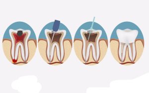 Sâu răng có cần điều trị tủy không