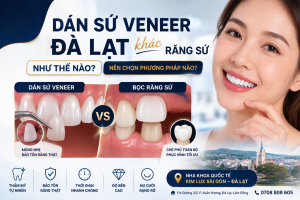 Dán sứ Veneer Đà Lạt