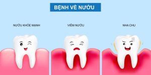 Benh viem nuou - Kimluxsaigondental