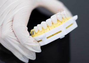 Răng sứ đà lạt tại Nha Khoa Kim Lux Sài Gòn