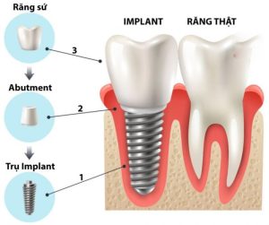 Cấu trúc của một ca cấy ghép implant