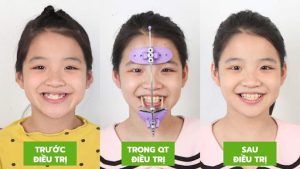 Chỉnh nha sớm cho bé