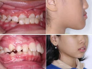 Chỉnh nha sớm cho trẻ