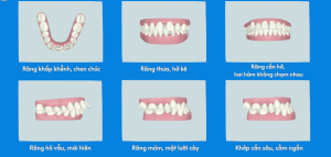 Những trường hợp nên chỉnh nha sớm cho trẻ