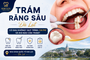 Trám răng sâu tại Đà Lạt