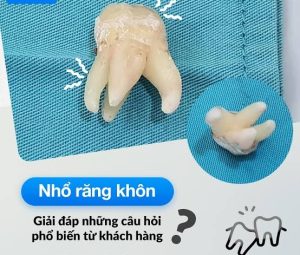 Những câu hỏi về nhổ răng khôn