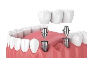 trồng răng implant là gì? trồng implant ở Đà Lạt