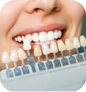 Dán sứ Veneer tại Đà Lạt