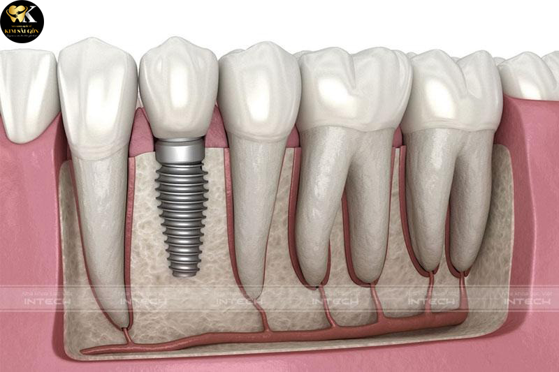 kim sai gon dental ky-thuat-trong-rang-implant