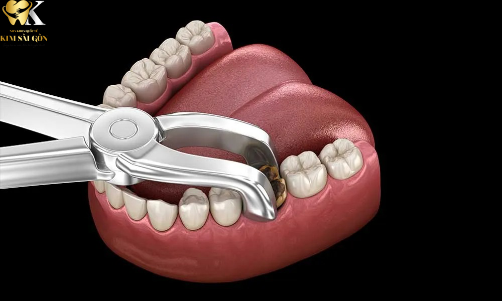 kim sai gon dental nho-rang-sau-co-anh-huong-gi-kho
