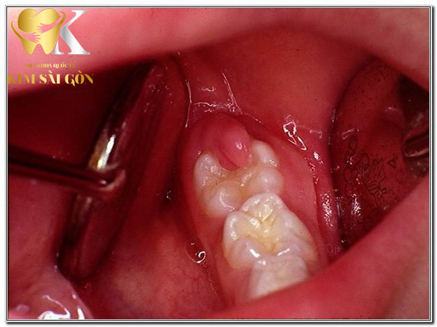 kim sai gon dental nhung-luu-y-khi-nho-rang-so-8-1