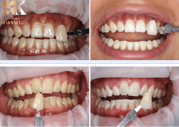 kim sai gon dental tay-trang-rang