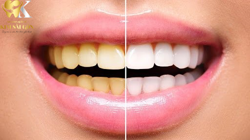 kim sai gon dental tay-trang-rang1