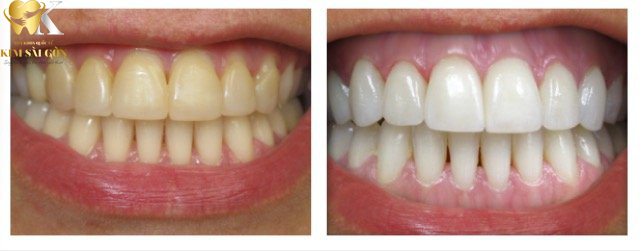 kim sai gon dental tay-trang-rang2