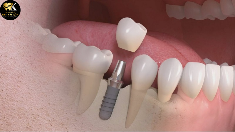 kim sai gon dental_dich-vu-cam-ghep-rang-gia-re