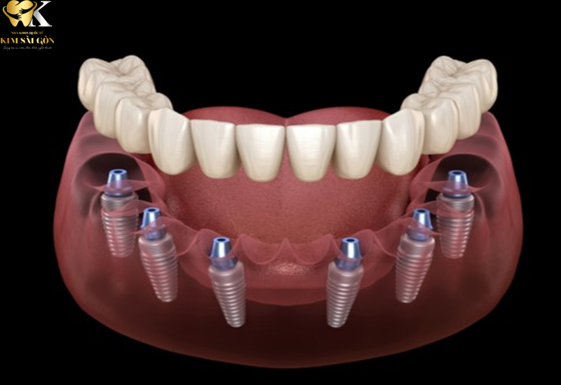 kim sai gon dental_implant-toan-ham-4