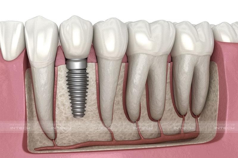 ky-thuat-trong-rang-implant