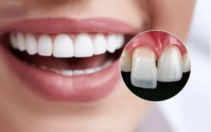 Dán sứ Veneer là gì?