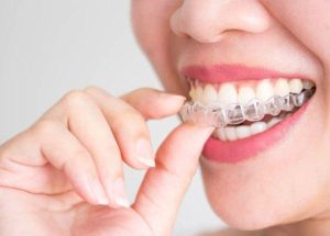 niềng răng trong suốt ở Đà Lạt