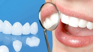 Răng sứ là gì?