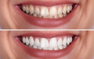 Tẩy trăng răng ở đà lạt - kimluxsaigondental