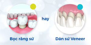 So sánh Răng sứ và Veneer