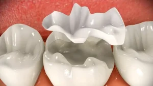 Vật liệu trám răng Composite