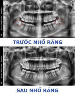 Nhổ răng khôn ở đà lạt