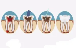 Sâu răng có cần điều trị tủy không