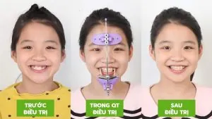 Chỉnh nha sớm cho bé