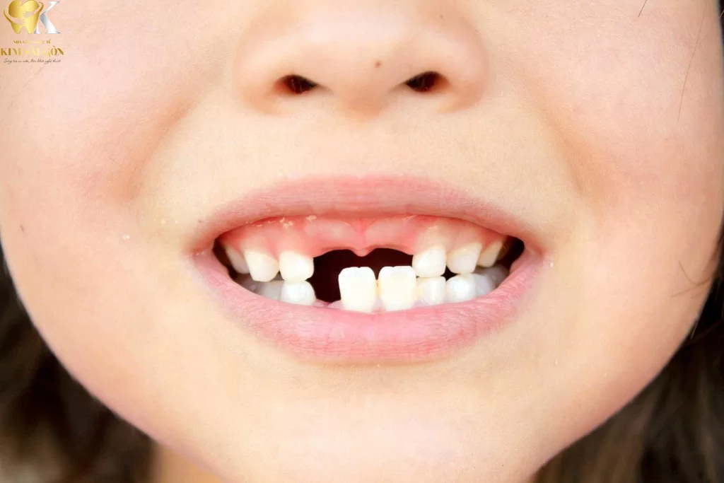 kim sai gon dental nha khoa tre em2