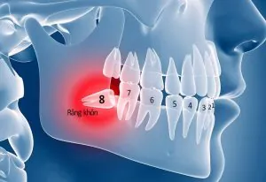 Nhổ răng khôn ở đà lạt